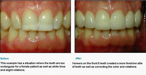 Teeth Whitening | Veneers | Aesthetic Dentistry | Altamash ...